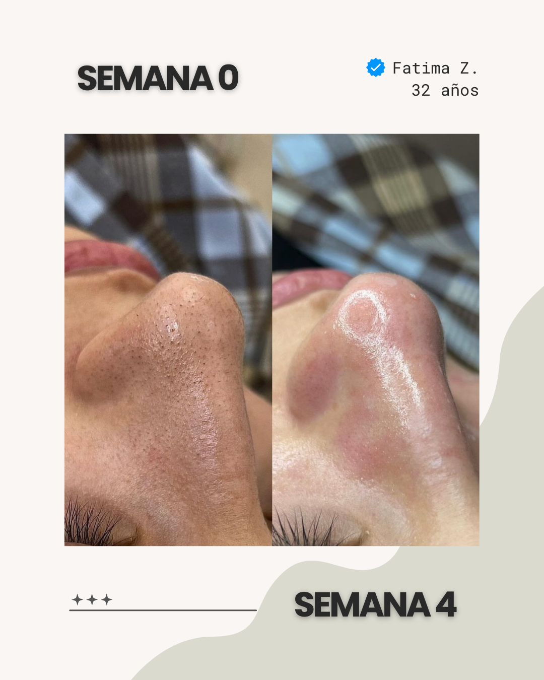 PureSkin® - Eliminador de puntos negros